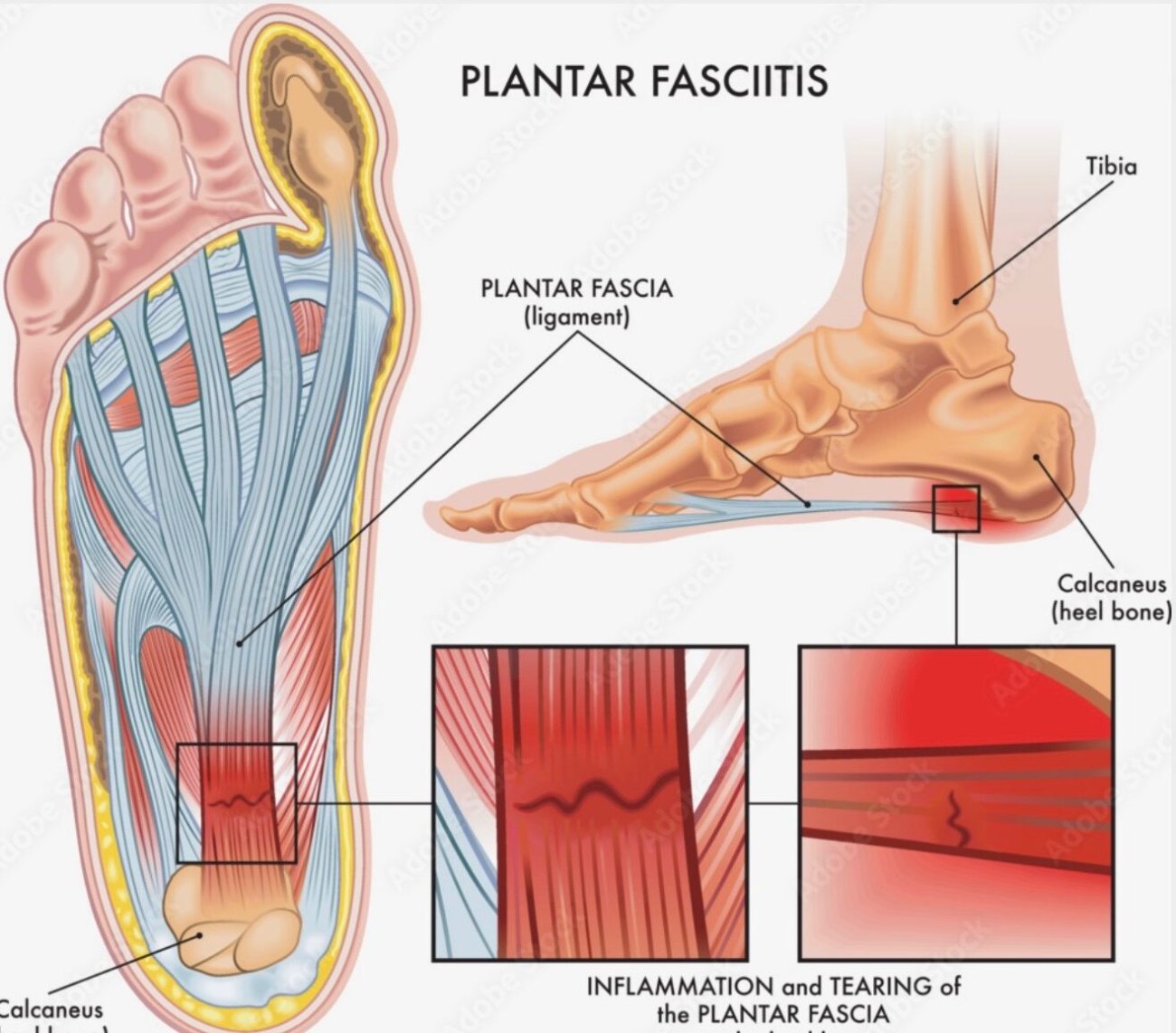 Plantar fascia anatomy diagram